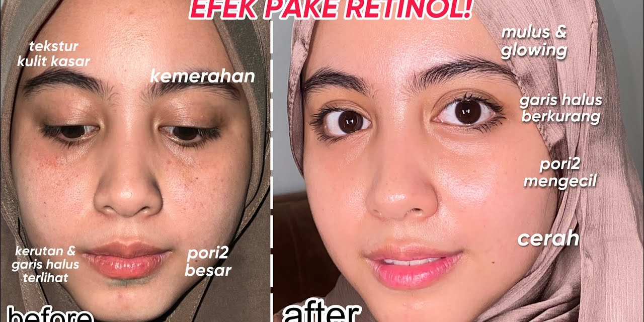 Ketahui Pentingnya Menggunakan Retinol Pada Wajah Lembutmu