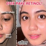 Ketahui Pentingnya Menggunakan Retinol Pada Wajah Lembutmu