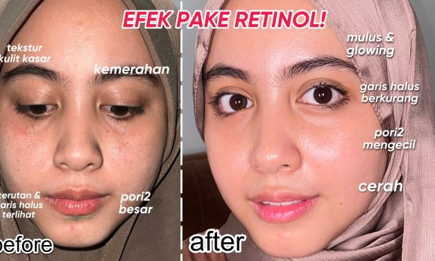 Ketahui Pentingnya Menggunakan Retinol Pada Wajah Lembutmu